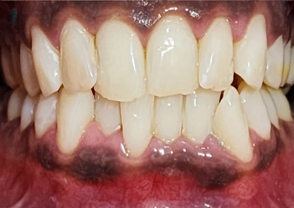 Cosmetic Dentistry - After